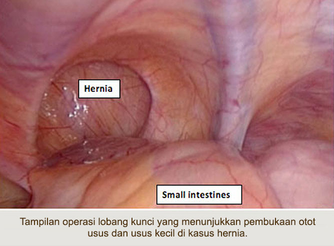 Hernia Surgery