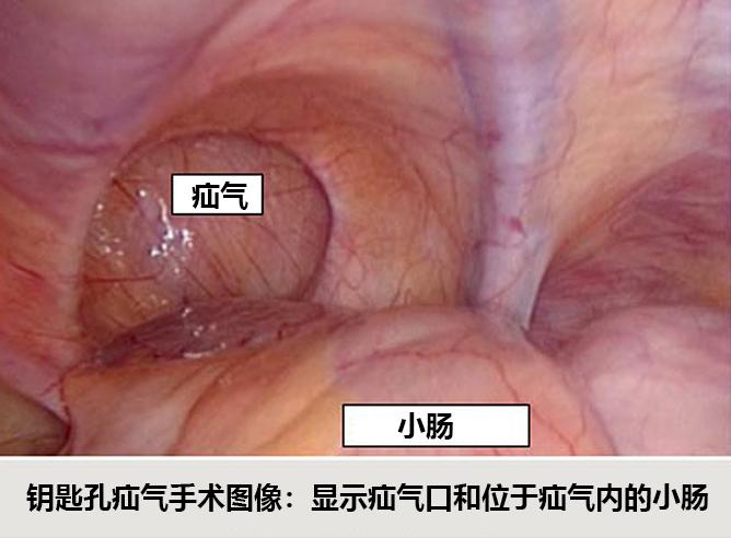 Hernia Surgery