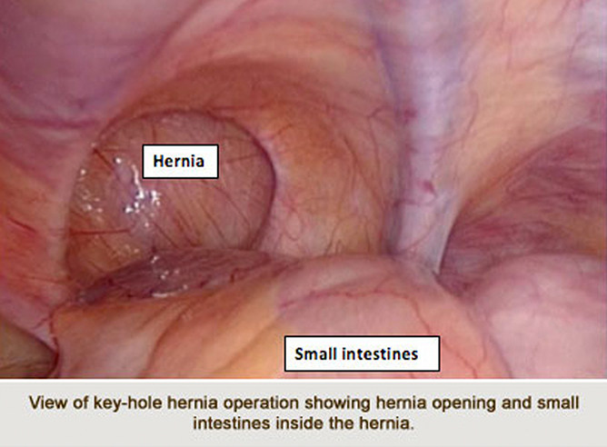 Hernia Surgery