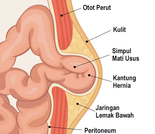 Hernia Surgery