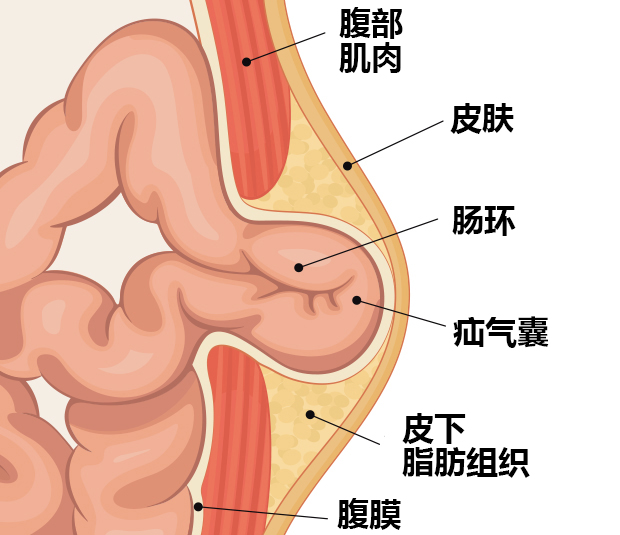 Hernia Surgery