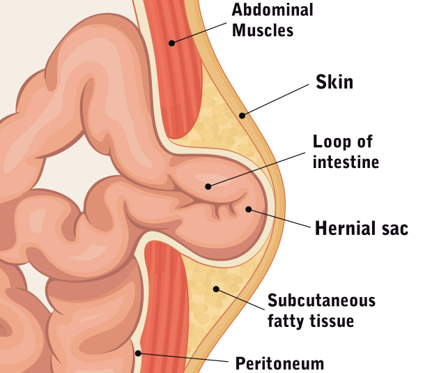 Hernia Surgery